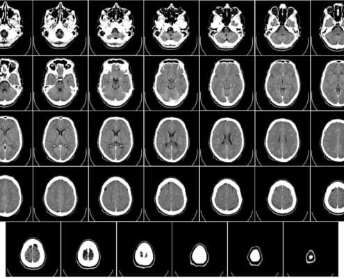 Catastrophic Brain Injury